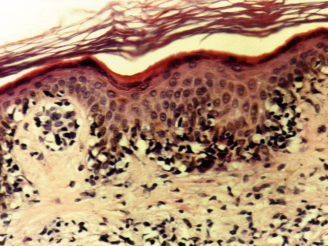 Fig.2: ATLL, Biopsia Cutnea - <div style=